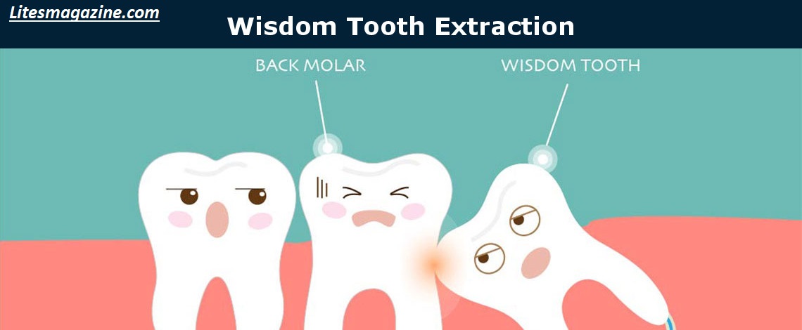Why Are Wisdom Teeth Called Wisdom Teeth? The Surprising Truth Revealed