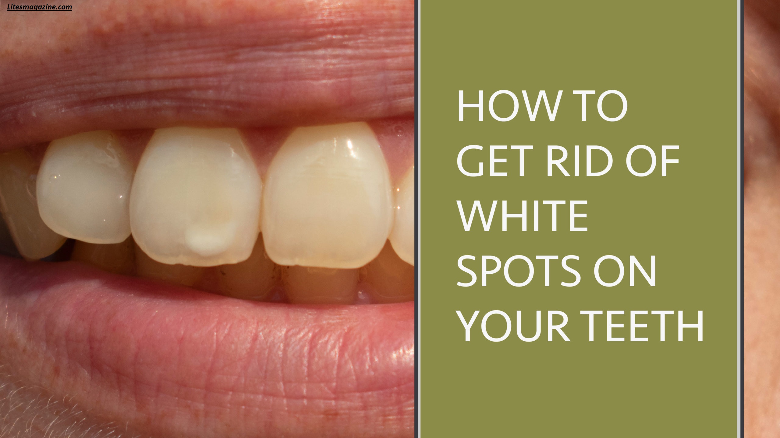 Why Do I Have White Spots on My Teeth? Causes Easy Fixes