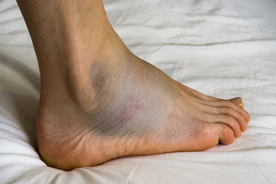 why are my feet swollen