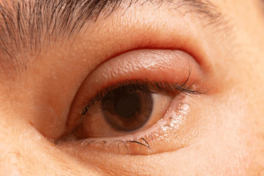 Why Is My Eye Swollen